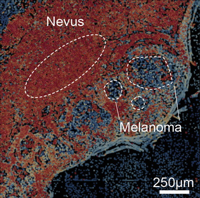 Melanoma slide image